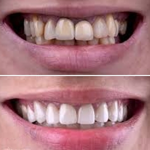 esthetische tandheelkunde almere